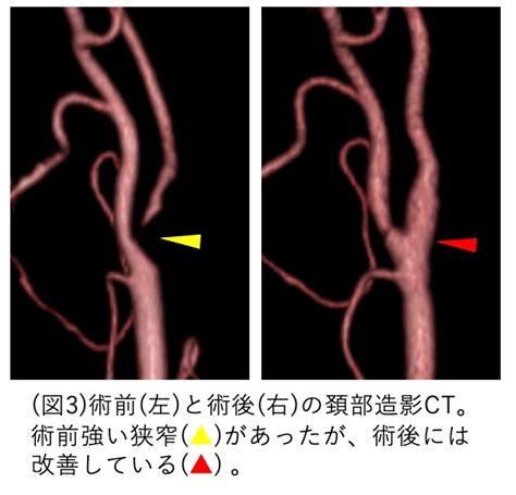 首 脈|ドックで見つかる頚動脈狭窄症って？